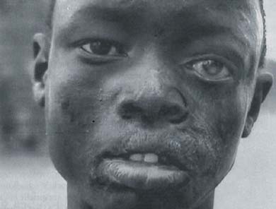 Ngor Mawien. Gazd&aacute;ja feles&eacute;ge 'sz&oacute;fogadatlans&aacute;ga' miatt forr&oacute; vizet &ouml;nt&ouml;tt az arc&aacute;ba. Ngor bal szem&eacute;re megvakult.